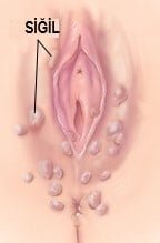 Genital Siğil - HPV - genital siğil - İstanbul kürtaj klinik
